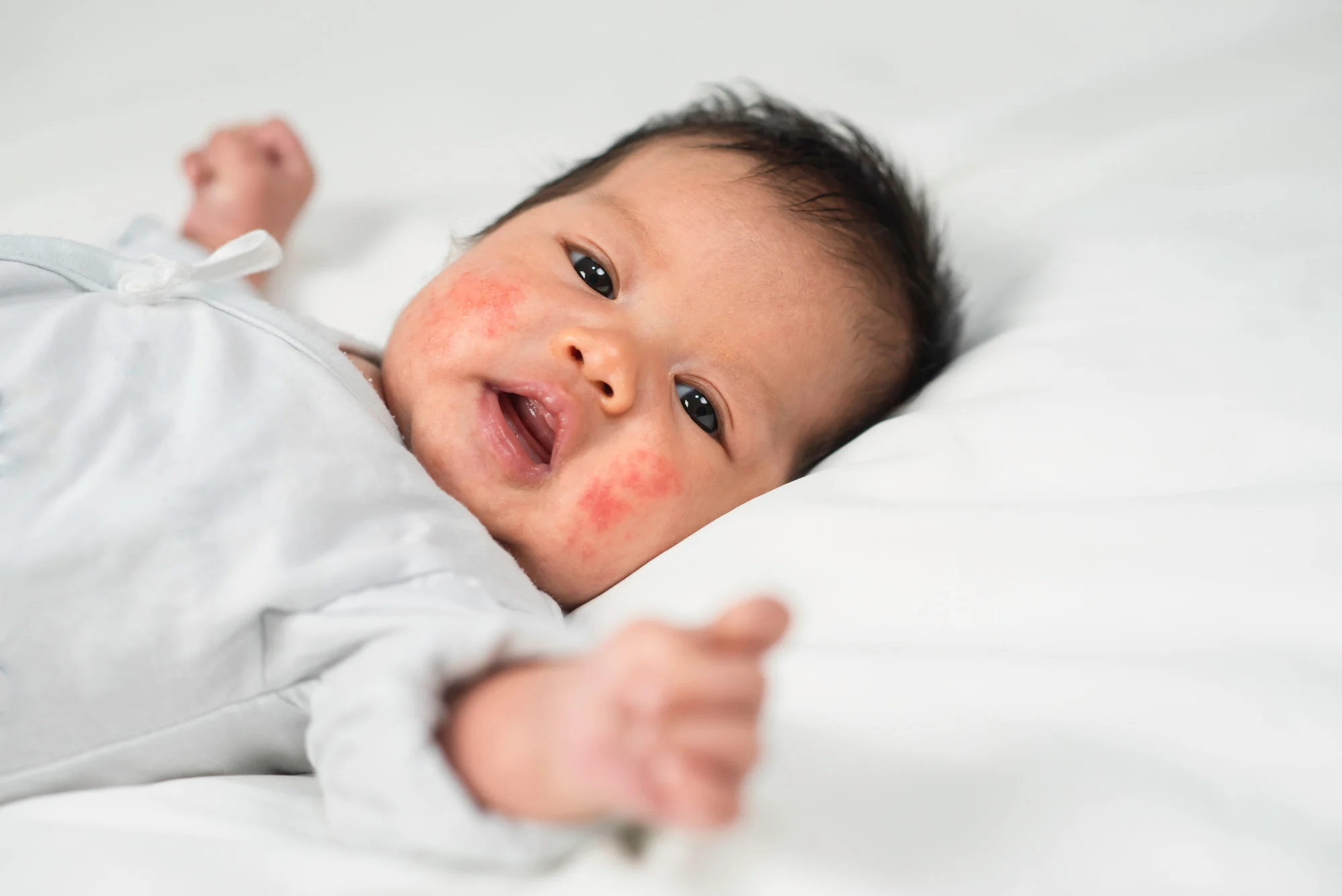Bệnh chàm thường thấy nhất ở trẻ sơ sinh và trẻ nhỏ. 