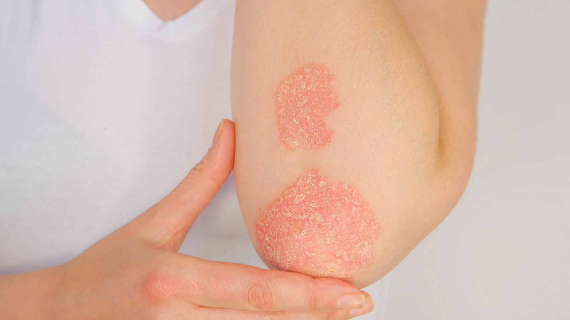 Bệnh vẩy nến gây phát ban khô, ngứa đặc trưng bởi các mảng da có vảy. 