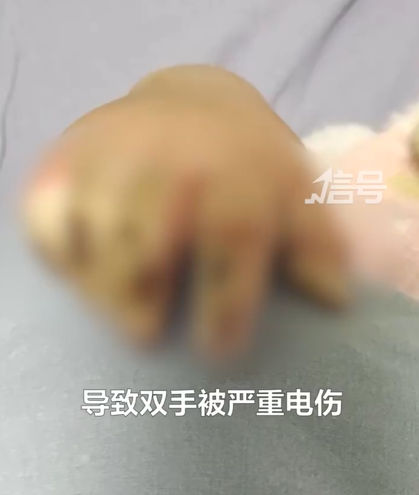 Bàn tay bé gái bị tổn thương nghiêm trọng.
