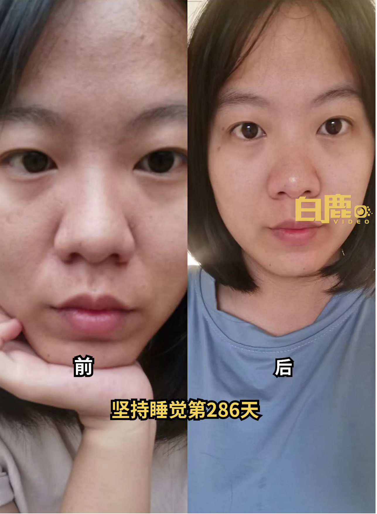 Hình ảnh thay đổi ngoạn mục trước và sau 286 ngày ngủ sớm của cô Liêu