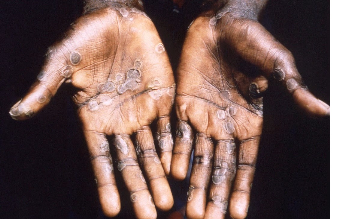 Lòng bàn tay của một bệnh nhân mắc bệnh đậu mùa khỉ. 